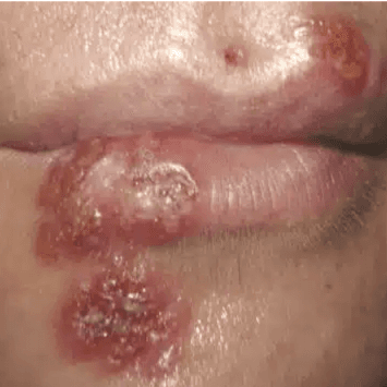 Cold Sore Package at Willow & Wood in Salina, KS