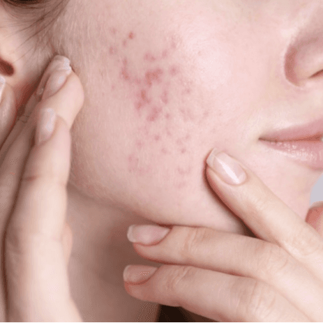 Acne Scar Program at Willow & Wood in Salina, KS